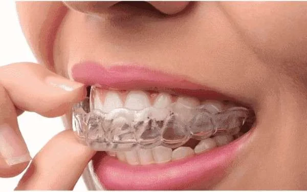 Invisible Braces vs Metal Braces in Tirupur | Which is Better?