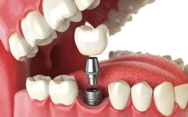 Dental Implants