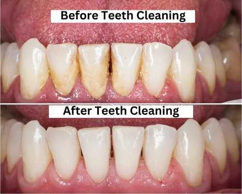 Teeth Cleaning Kavithas Dental Enclave Tirupur 