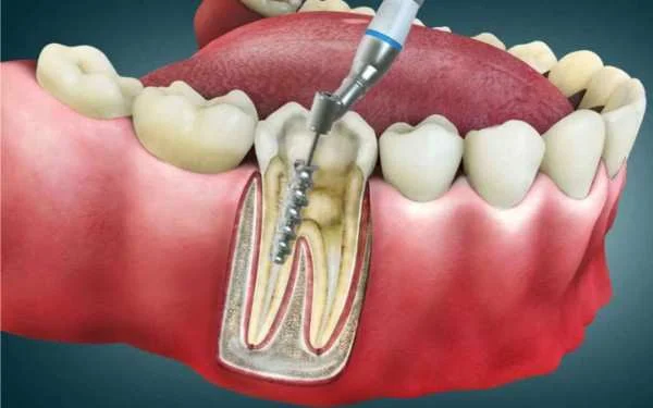 7 Signs You Need a Root Canal | Pain-Free RCT in Tirupur