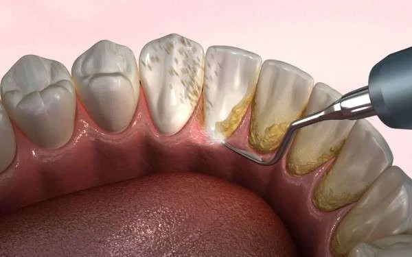 Dental Cleaning and Scaling in Tirupur