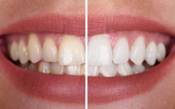 Professional Teeth Whitening in Tirupur | Safe & Fast Results