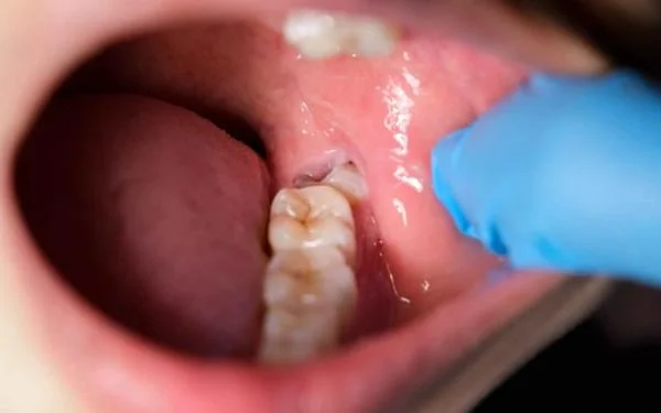 Emergency Dentist in Tirupur | Immediate Dental First Aid