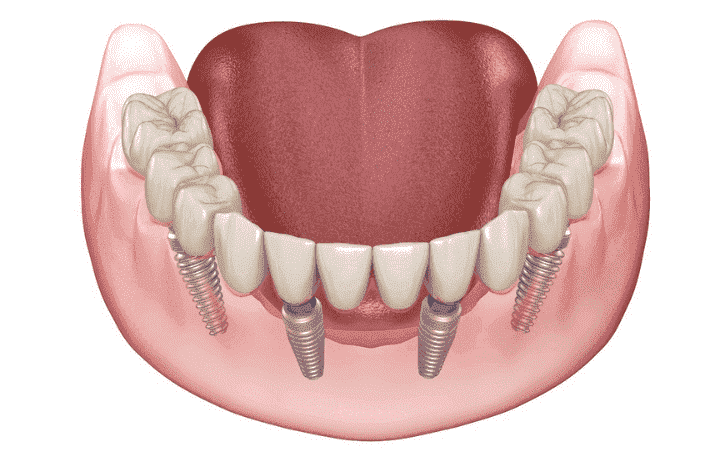 Full Mouth Rehabilitation - Kavithas dental enclave clinic tirupur​​​