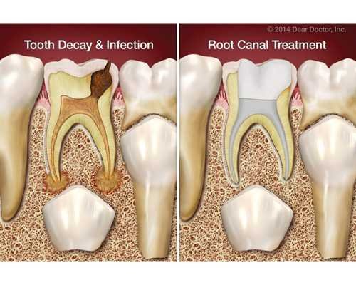 Root Canal Treatment - Kavithas Dental Enclave Tirupur​