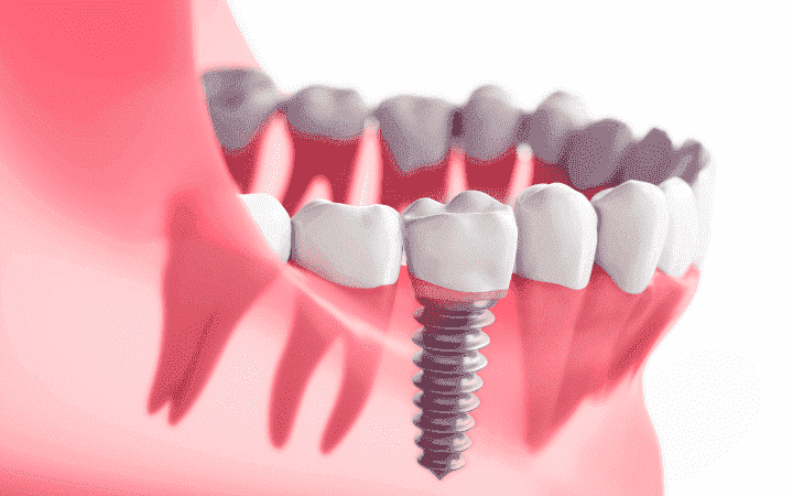 dental implants- Kavithas dental enclave clinic tirupur